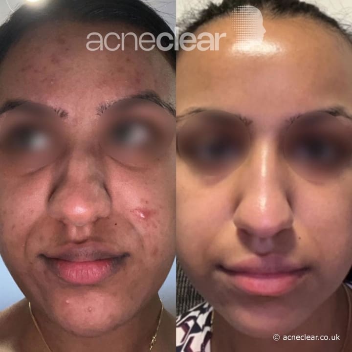 acneclear - patient image