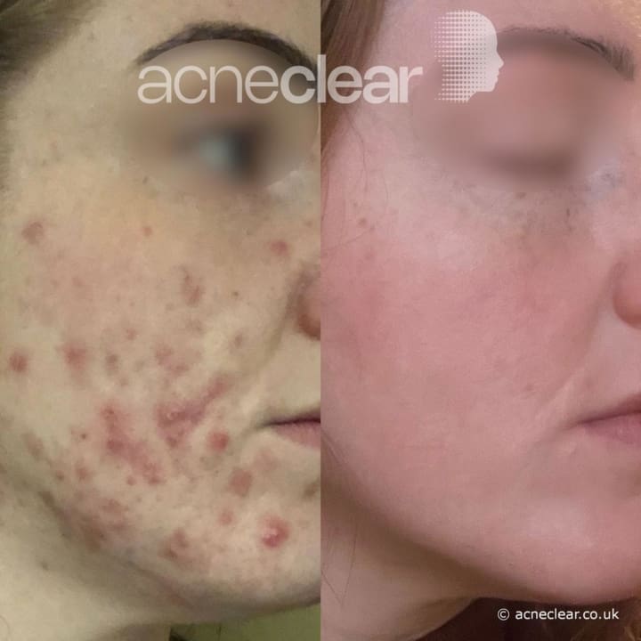 acneclear - patient image